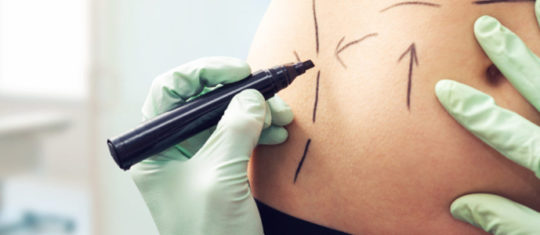 liposuccion