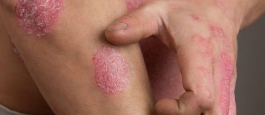 Psoriasis