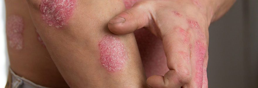 Psoriasis